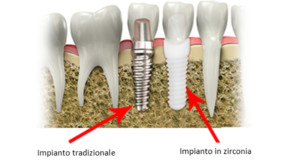 Impianti dentali: zirconia vs titanio.