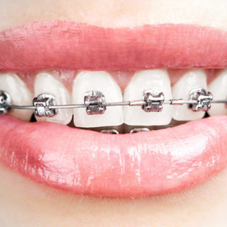 A cosa servono gli apparecchi dentali?