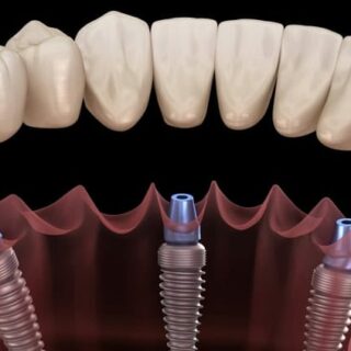 Implantologia Dentale Roma: guida completa