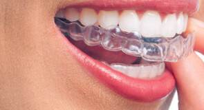 Ortodonzia Invisibile: La Rivoluzione nel Sorriso Moderno