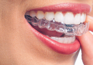 Ortodonzia Invisibile: La Rivoluzione nel Sorriso Moderno