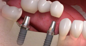 Protesi Dentale: Una Panoramica sulle Varie Tipologie e le Loro Funzioni