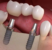 Protesi Dentale: Una Panoramica sulle Varie Tipologie e le Loro Funzioni