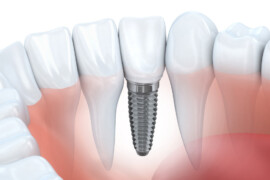 Implantologia Dentale: Una Soluzione Innovativa per il  tuo Sorriso