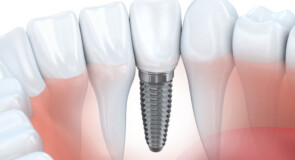Implantologia Dentale: Una Soluzione Innovativa per il  tuo Sorriso