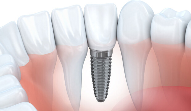 Implantologia Dentale: Una Soluzione Innovativa per il  tuo Sorriso
