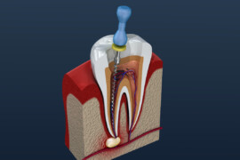 Studio dentistico a Roma: Approfondimento sui Canali e la Devitalizzazione dei Denti