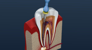 Studio dentistico a Roma: Approfondimento sui Canali e la Devitalizzazione dei Denti