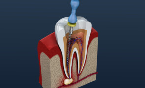 Studio dentistico a Roma: Approfondimento sui Canali e la Devitalizzazione dei Denti