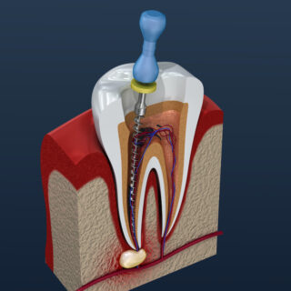 Studio dentistico a Roma: Approfondimento sui Canali e la Devitalizzazione dei Denti