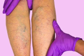 Disturbi della circolazione nelle gambe: riconoscerli e affrontarli