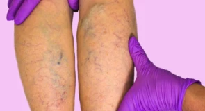 Disturbi della circolazione nelle gambe: riconoscerli e affrontarli