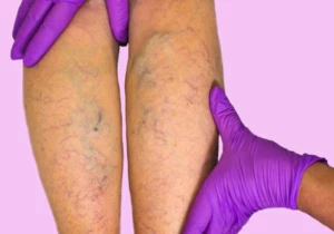 Disturbi della circolazione nelle gambe: riconoscerli e affrontarli