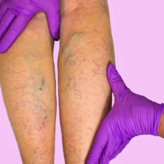 Disturbi della circolazione nelle gambe: riconoscerli e affrontarli