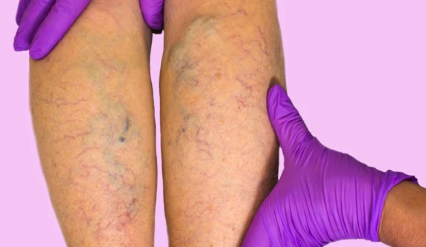 circolazione gambe vene varicose